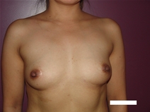 Breast Augmentation Before Photo by Moneer Jaibaji, MD; Coronado, CA - Case 22635