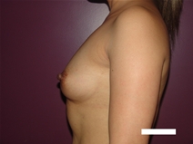 Breast Augmentation Before Photo by Moneer Jaibaji, MD; Coronado, CA - Case 22635