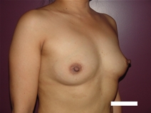 Breast Augmentation Before Photo by Moneer Jaibaji, MD; Coronado, CA - Case 22635