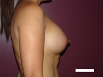 Breast Augmentation After Photo by Moneer Jaibaji, MD; Coronado, CA - Case 22635