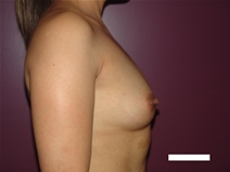 Breast Augmentation Before Photo by Moneer Jaibaji, MD; Coronado, CA - Case 22635