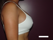 Breast Augmentation After Photo by Moneer Jaibaji, MD; Coronado, CA - Case 22635