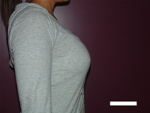 Breast Augmentation After Photo by Moneer Jaibaji, MD; Coronado, CA - Case 22635