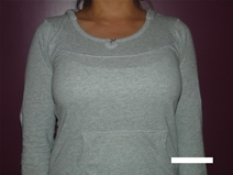 Breast Augmentation Before Photo by Moneer Jaibaji, MD; Coronado, CA - Case 22635