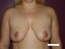 Breast Reduction After Photo by Moneer Jaibaji, MD; Coronado, CA - Case 22668