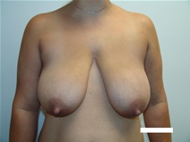 Breast Reduction Before Photo by Moneer Jaibaji, MD; Coronado, CA - Case 22668