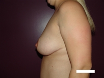 Breast Reduction After Photo by Moneer Jaibaji, MD; Coronado, CA - Case 22668