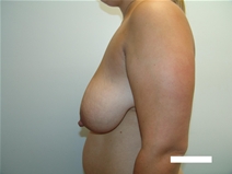 Breast Reduction Before Photo by Moneer Jaibaji, MD; Coronado, CA - Case 22668