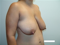 Breast Reduction Before Photo by Moneer Jaibaji, MD; Coronado, CA - Case 22668