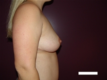 Breast Reduction After Photo by Moneer Jaibaji, MD; Coronado, CA - Case 22668