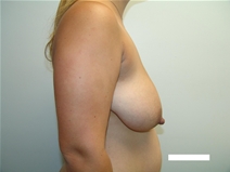 Breast Reduction Before Photo by Moneer Jaibaji, MD; Coronado, CA - Case 22668