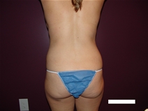 Liposuction Before Photo by Moneer Jaibaji, MD; Coronado, CA - Case 22669