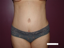 Liposuction After Photo by Moneer Jaibaji, MD; Coronado, CA - Case 22669