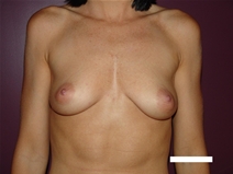 Breast Augmentation Before Photo by Moneer Jaibaji, MD; Coronado, CA - Case 22708