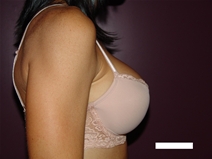 Breast Augmentation After Photo by Moneer Jaibaji, MD; Coronado, CA - Case 22708