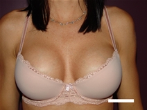 Breast Augmentation Before Photo by Moneer Jaibaji, MD; Coronado, CA - Case 22708