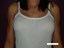 Breast Augmentation Before Photo by Moneer Jaibaji, MD; Coronado, CA - Case 22708