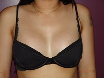 Breast Augmentation Before Photo by Moneer Jaibaji, MD; Coronado, CA - Case 22719
