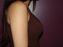 Breast Augmentation After Photo by Moneer Jaibaji, MD; Coronado, CA - Case 22719
