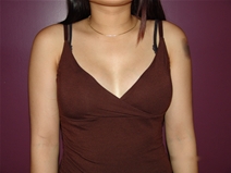 Breast Augmentation Before Photo by Moneer Jaibaji, MD; Coronado, CA - Case 22719
