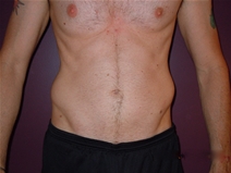 Liposuction After Photo by Moneer Jaibaji, MD; Coronado, CA - Case 22736