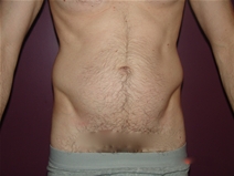 Liposuction Before Photo by Moneer Jaibaji, MD; Coronado, CA - Case 22736