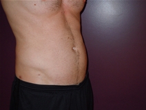 Liposuction After Photo by Moneer Jaibaji, MD; Coronado, CA - Case 22736