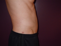 Liposuction After Photo by Moneer Jaibaji, MD; Coronado, CA - Case 22736