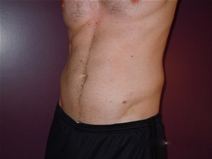 Liposuction After Photo by Moneer Jaibaji, MD; Coronado, CA - Case 22736