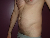 Liposuction Before Photo by Moneer Jaibaji, MD; Coronado, CA - Case 22736