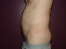 Liposuction Before Photo by Moneer Jaibaji, MD; Coronado, CA - Case 22736