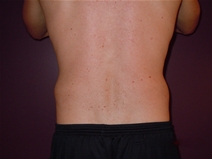 Liposuction After Photo by Moneer Jaibaji, MD; Coronado, CA - Case 22736