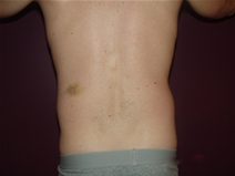 Liposuction Before Photo by Moneer Jaibaji, MD; Coronado, CA - Case 22736