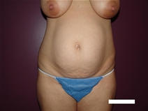 Tummy Tuck Before Photo by Moneer Jaibaji, MD; Coronado, CA - Case 22737