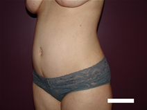 Tummy Tuck After Photo by Moneer Jaibaji, MD; Coronado, CA - Case 22737