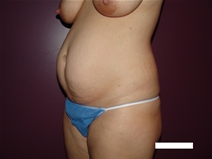 Tummy Tuck Before Photo by Moneer Jaibaji, MD; Coronado, CA - Case 22737
