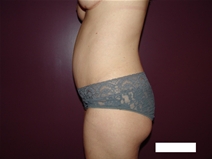 Tummy Tuck After Photo by Moneer Jaibaji, MD; Coronado, CA - Case 22737