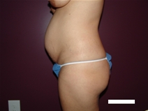 Tummy Tuck Before Photo by Moneer Jaibaji, MD; Coronado, CA - Case 22737