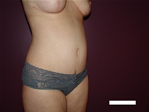 Tummy Tuck After Photo by Moneer Jaibaji, MD; Coronado, CA - Case 22737