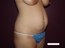 Tummy Tuck Before Photo by Moneer Jaibaji, MD; Coronado, CA - Case 22737