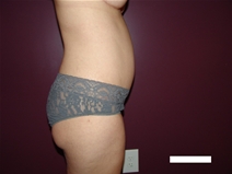 Tummy Tuck After Photo by Moneer Jaibaji, MD; Coronado, CA - Case 22737