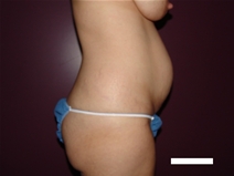 Tummy Tuck Before Photo by Moneer Jaibaji, MD; Coronado, CA - Case 22737