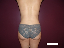 Tummy Tuck After Photo by Moneer Jaibaji, MD; Coronado, CA - Case 22737