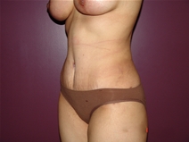 Tummy Tuck After Photo by Moneer Jaibaji, MD; Coronado, CA - Case 22780