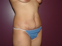 Tummy Tuck Before Photo by Moneer Jaibaji, MD; Coronado, CA - Case 22780