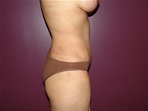 Tummy Tuck After Photo by Moneer Jaibaji, MD; Coronado, CA - Case 22780