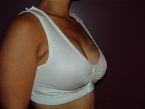 Breast Lift After Photo by Moneer Jaibaji, MD; Coronado, CA - Case 22782