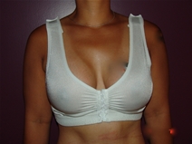 Breast Lift Before Photo by Moneer Jaibaji, MD; Coronado, CA - Case 22782