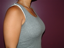 Breast Lift After Photo by Moneer Jaibaji, MD; Coronado, CA - Case 22782