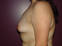 Breast Augmentation Before Photo by Moneer Jaibaji, MD; Coronado, CA - Case 22910